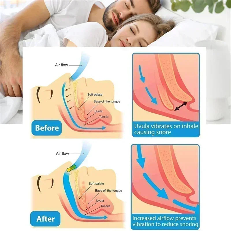 Effective Anti-Snoring Devices for peaceful nights.